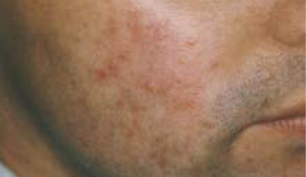 Acne BEFORE