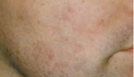 Acne AFTER