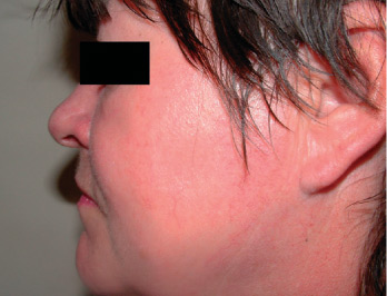 Red Vein Removal BEFORE