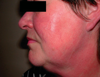 Red Vein Removal AFTER